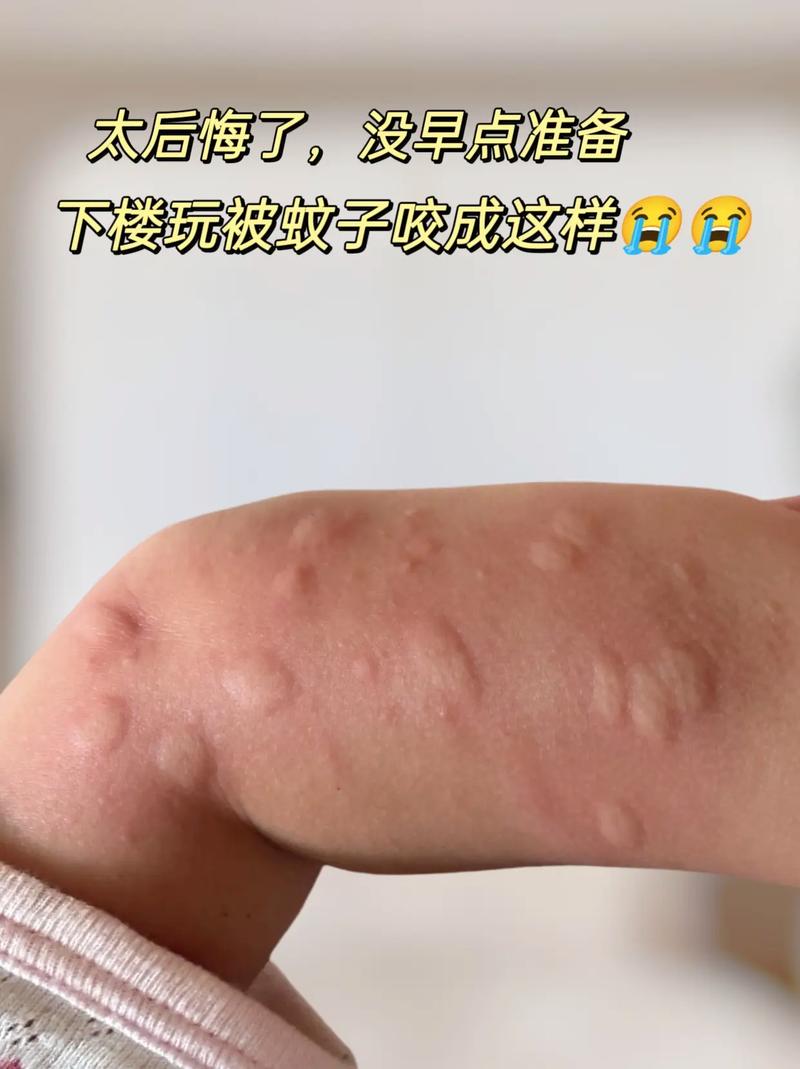 蚊子叮人蚂蚁庄园被咬肿咋办？快速止痒方法推荐