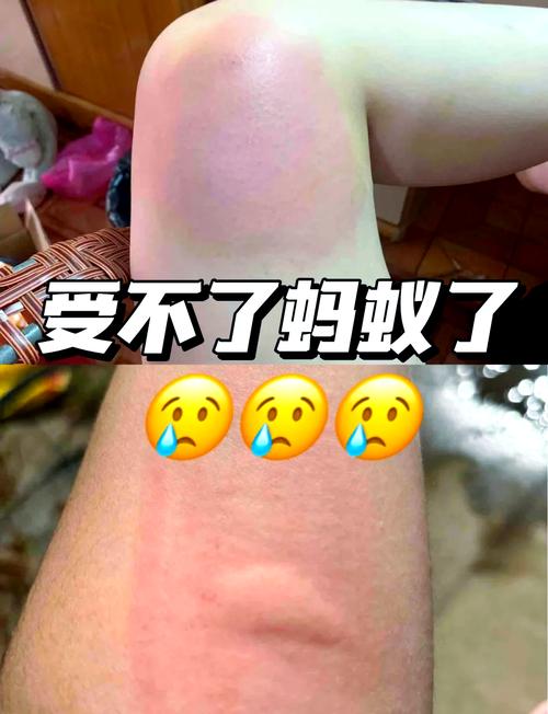 蚊子叮人蚂蚁庄园被咬肿咋办？快速止痒方法推荐