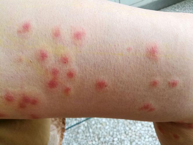 蚊子叮人蚂蚁庄园被咬肿咋办？快速止痒方法推荐