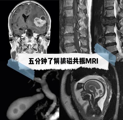 核磁共振为什么要取下金属蚂蚁？5个安全风险必须知道！