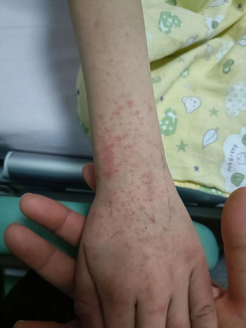 ebola症状有哪些?出现这些信号要立即就医