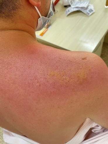 冬天频繁洗澡伤皮肤？三招教你避免发红脱屑！