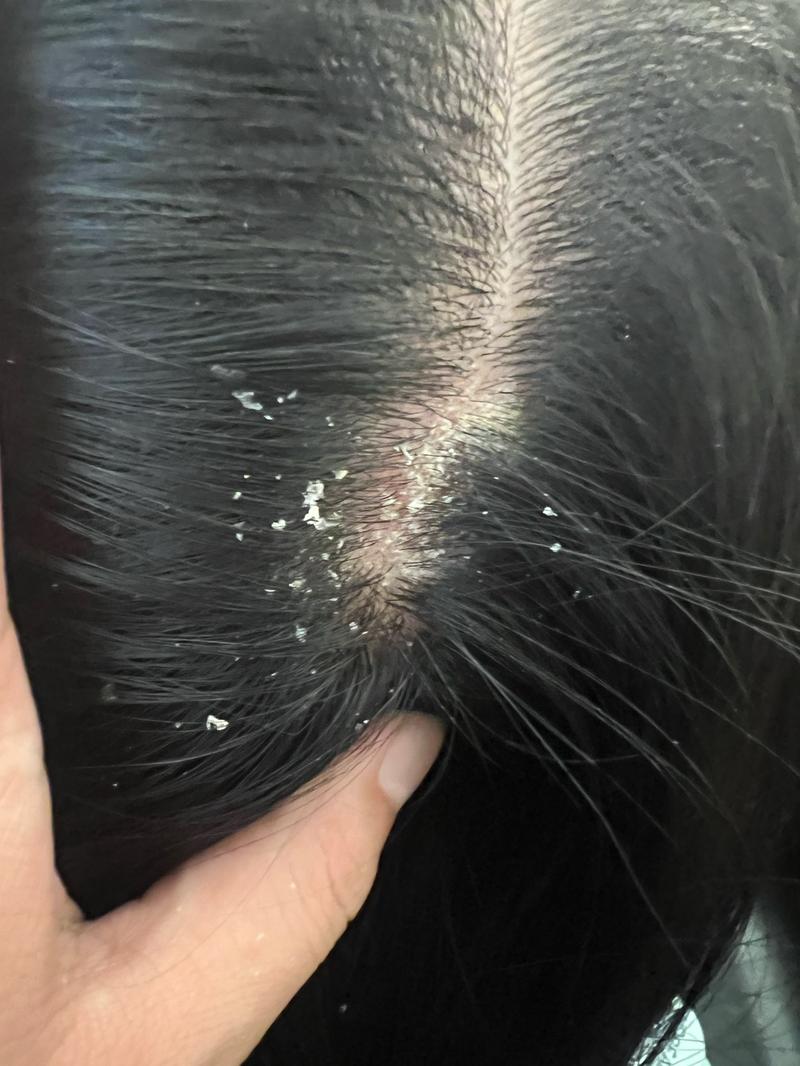 头皮痒头皮屑多有可能传染吗蚂蚁？实用指南保护家人健康！