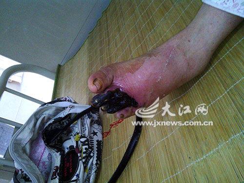 遗失的义肢有啥影响？关乎患者生活大问题！